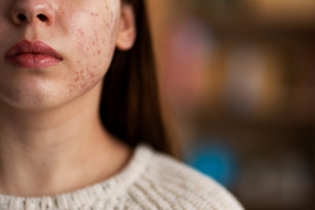 Disrupted skin barrier after an aggressive skincare routine