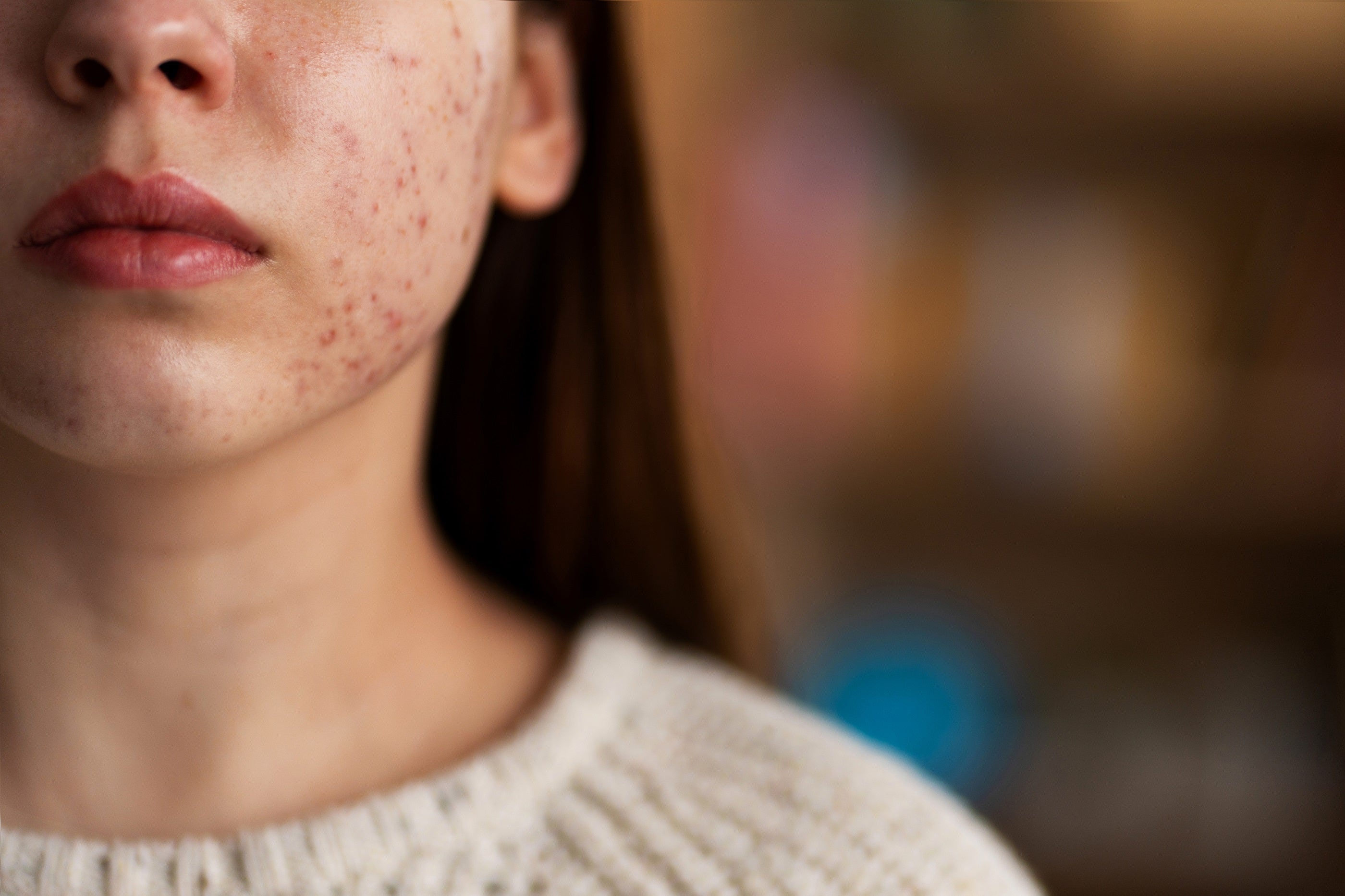 Disrupted skin barrier after an aggressive skincare routine